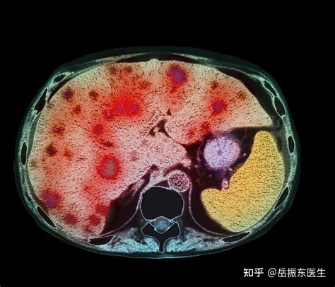 肝癌转移后，身体会出现这6种症状，别不当回事 知乎