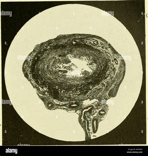 Fig 147Chronic Catarrhal Salpingitis The Mucous Folds Have Been