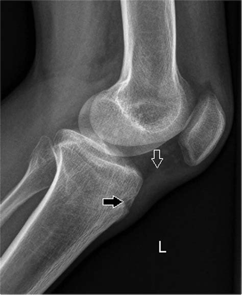 X Ray Knee Patellar Tendonitis at Loretta Sams blog