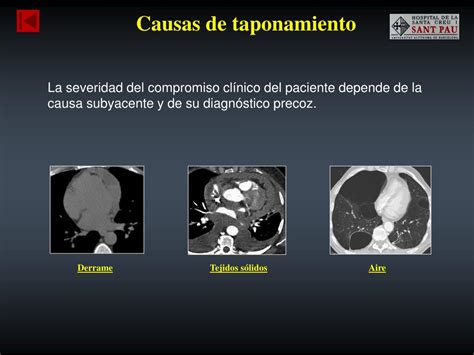 PPT Taponamiento cardíaco Causas y hallazgos radiológicos PowerPoint