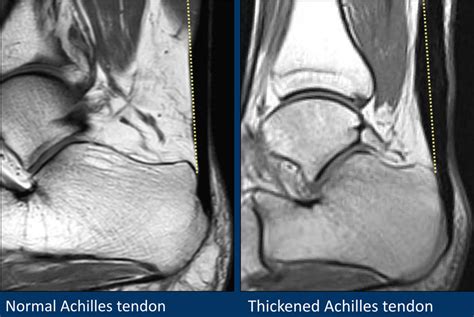 Mri Ankle Torn Tendon