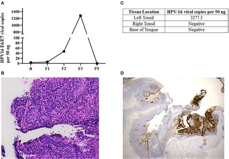 An Occult Hpv Driven Oropharyngeal Squamous Cell Carcinoma Discovered Through A Saliva Test