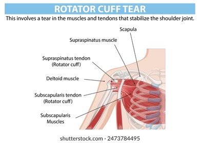 Detailed Anatomy Shoulder Rotator Cuff Tear Stock Vector (Royalty Free ...