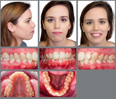 Scielo Brasil Marpe As An Adjunct To Orthodontic Treatment Marpe As