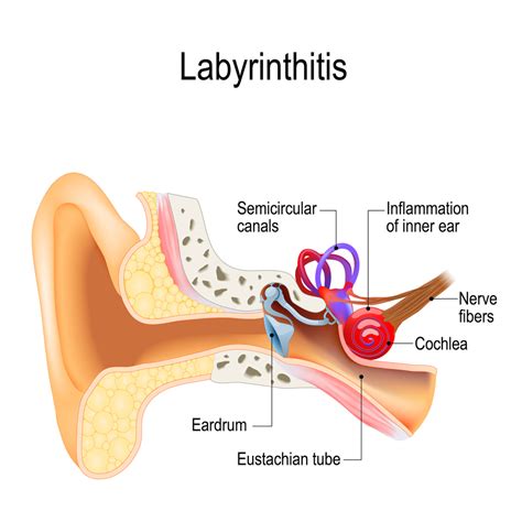 Vestibular Neuritis: Symptoms, Causes Treatment, 46% OFF