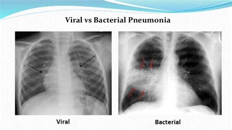 Chest Radiograph Pneumonia