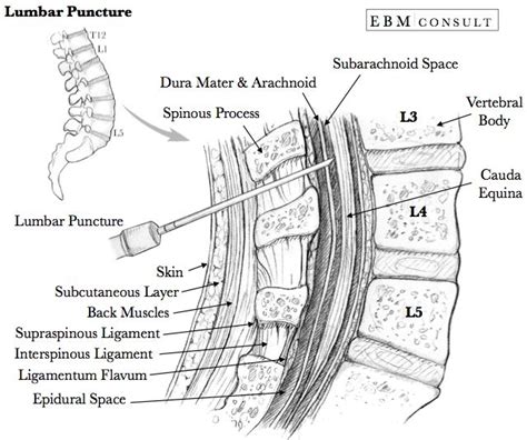 Procedure How To Do A Lumbar Puncture Lumbar Puncture Spinal