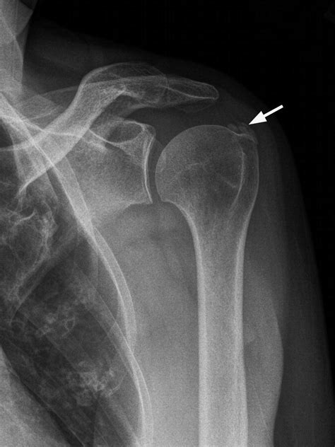 In Shoulder Radiology Musculoskeletal Key