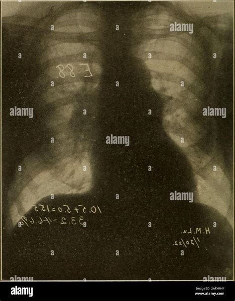 Pulmonary atresia hi-res stock photography and images - Alamy