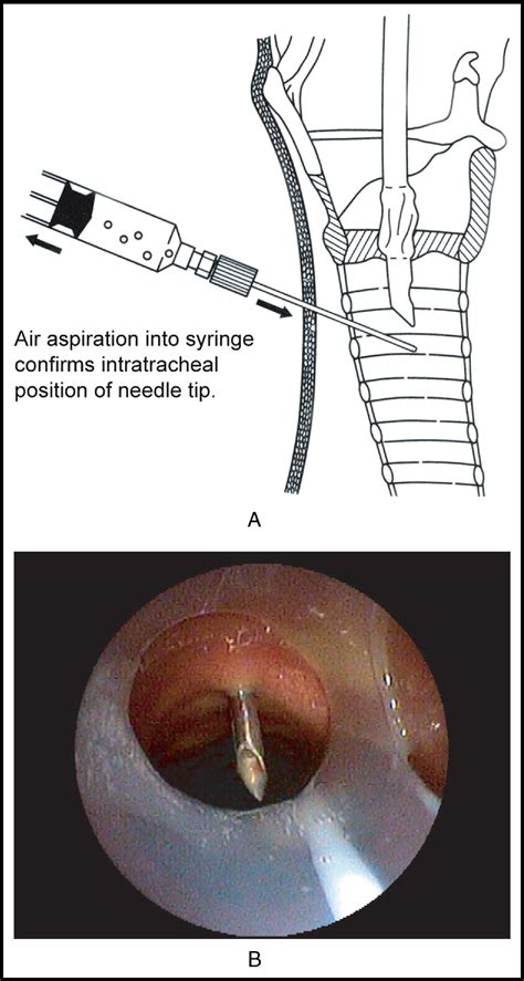 Percutaneous Tracheostomy Placement With External Laser Light