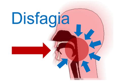 La Disfagia Es La Dificultad Para La Deglución Sus Características Sospecha Y Diagnóstico