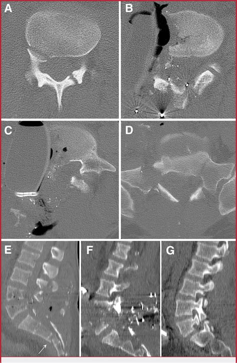 Figure 1 From U‐shaped Sacral Fracture And Lumbosacral Dislocation As A Result Of A Shotgun