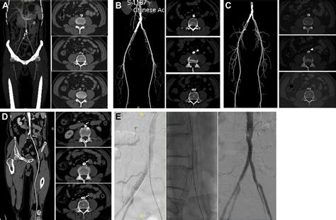 Midterm Outcomes Of Kissing Covered Self Expanding Stents For