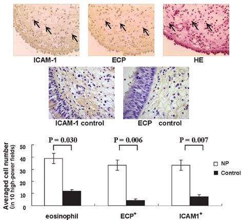 Distribution Of Total Infiltrating And Activated Eosinophils In The Np