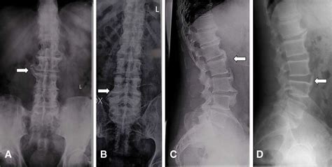 Diffuse Idiopathic Skeletal Hyperostosis Cervical Spine