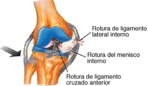 Tríada la lesión de rodilla que más afecta a los deportistas MENzig