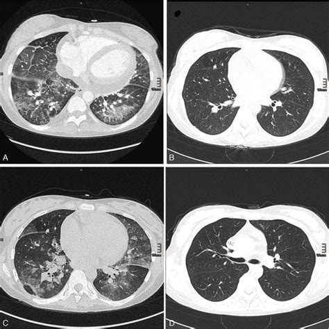 A) Diffuse pulmonary hemorrhage in both lower lobes, which resolved ...