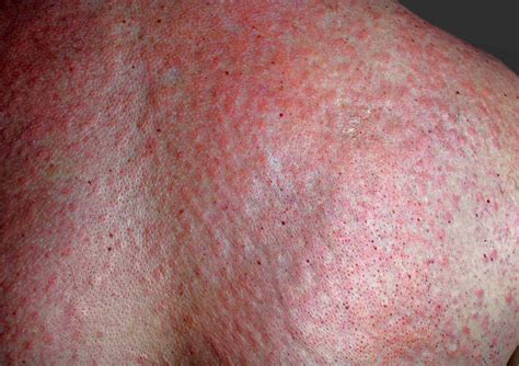 Hives Urticaria Types Symptoms Treatment And More