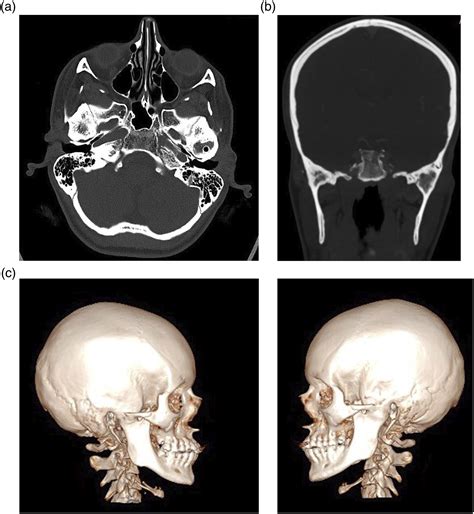 Bilateral Tmj Ankylosis Total Joint Reconstruction In A Patient With