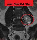 Schwannoma Psoas Spine Surgery Greece