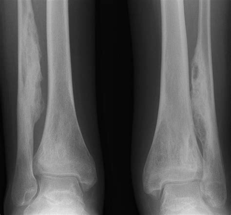 Imaging Of Chronic Recurrent Multifocal Osteomyelitis RadioGraphics