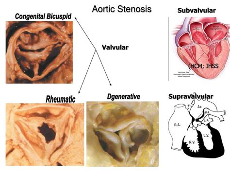 Ppt Aortic Stenosis Powerpoint Presentation Free Download Id3493665