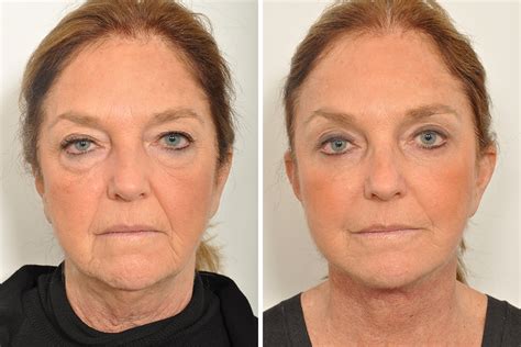 Endoscopic Brow Lift Forehead Lift For Women In New York City David