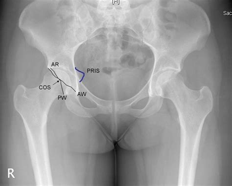 Ischial Spine X Ray