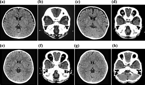 Subarachnoid Space Hemorrhage Ultrasound