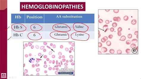 Hematology 2 U1 L22 Abnormal Hemoglobins Youtube