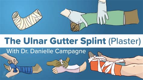 Hd Ulnar Gutter Plaster Orthopedic Fundamentals Splinting Emrap