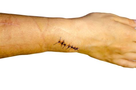 Stitches After Surgery Isolated Background Stock Photo Image Of Pain