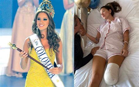 Fue Al Hospital A Cirugía Menor Y Le Amputaron Una Pierna La Historia De Miss Colombia