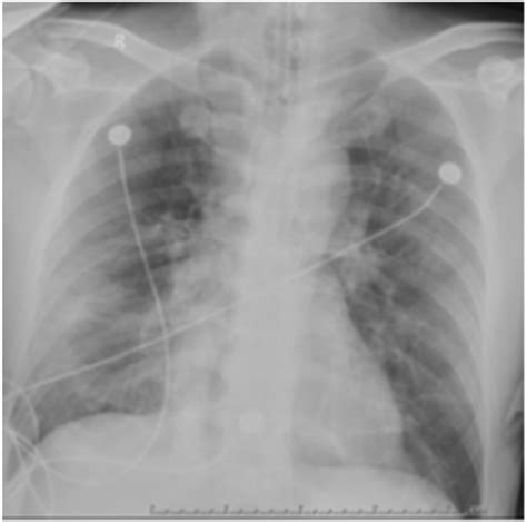 Chest X‐ray of critically ill patient with COVID‐19 pneumonia. | Download Scientific Diagram