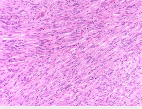 Superficial Cd34 Positive Fibroblastic Tumor Hande Staining Shows