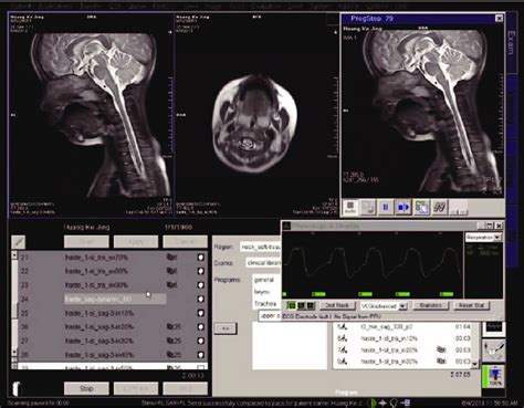 Panel For Setting The Parameters Of The Mri Respiratory Gating