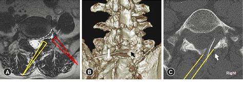 Figure 3 From A Novel Technique Of The Full Endoscopic Interlaminar Contralateral Approach For