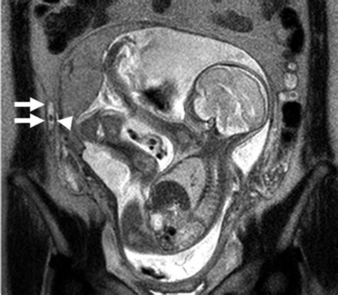 Mri Pregnancy Scan Pregnancywalls