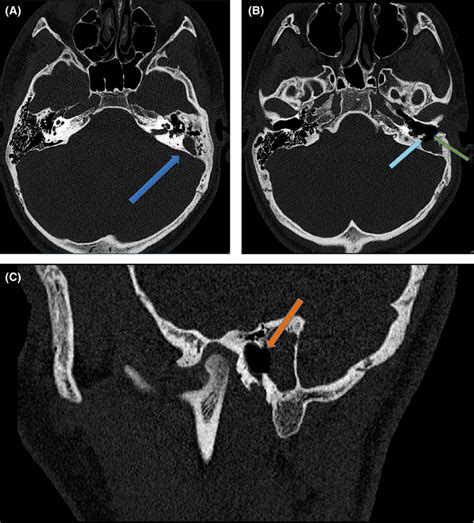 High‐resolution temporal bone CT scan. (A) Blue arrow—Opacified left... | Download Scientific ...