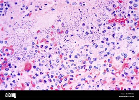 Photomicrograph Of Giemsa Stained Lung Tissue From A Patient With Fatal