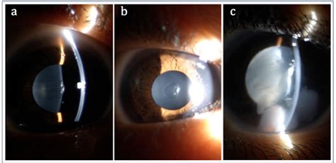 Figure From Bilateral Spontaneous Anterior Lens Capsule Ruptures In A