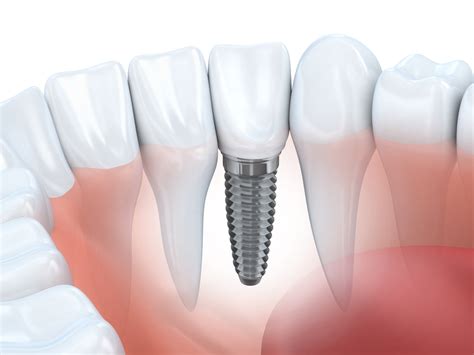 Dental Implants: How Long Is The Recovery Time For Implant Surgery?