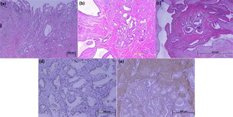 Photomicrographs Of Gallbladder Sections A Proliferation Of The