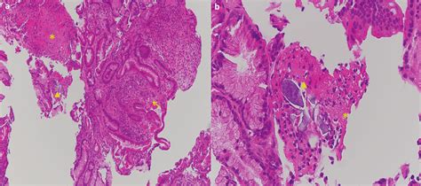 Biopsy Specimen Of The Duodenal Ulcer Stained With Haematoxylin And