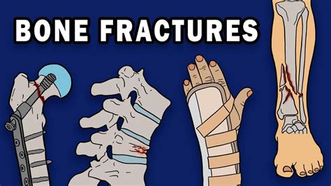 Signs Of Bone Fracture