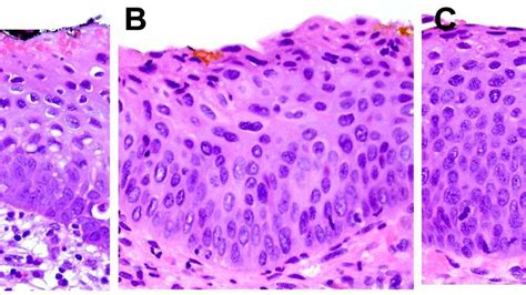 Cervical Intraepithelial Neoplasia