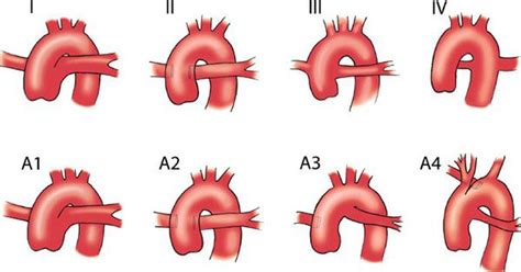 Truncus Arteriosus Types