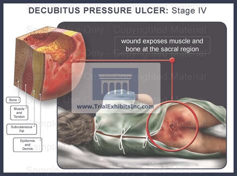 This Ain T No Game Show Stage Iii Stage Iv Pressure Ulcer