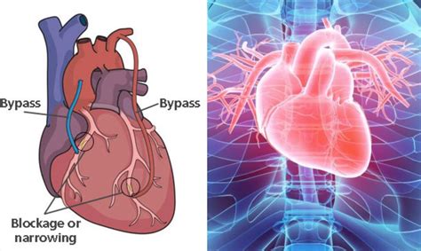 Bypass Surgery in Bangladesh - Professor AKM Manzurul Alam