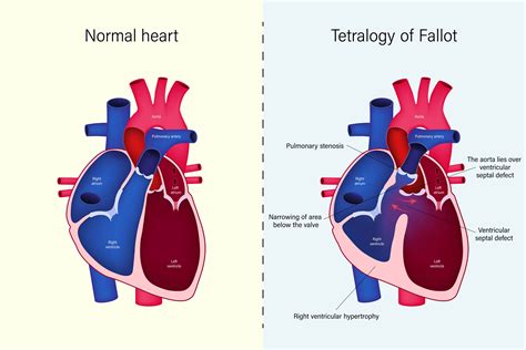 Tetralogia De Fallot O Que Voc Precisa Saber Fetalmed